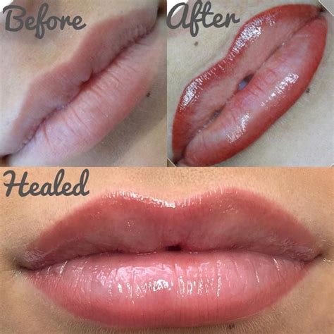 💋👄💉 Stages of lip procedure 🙌🏻 seamless, airbrushed part lip blend. Not a lipstick look, just ...