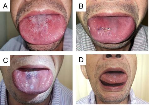 Amyloidosis of the tongue: a rare case report | Brazilian Journal of Otorhinolaryngology