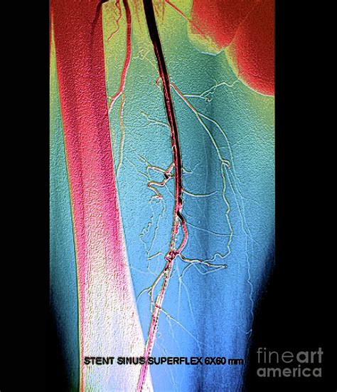 Leg Artery Angioplasty Photograph by Zephyr/science Photo Library - Fine Art America