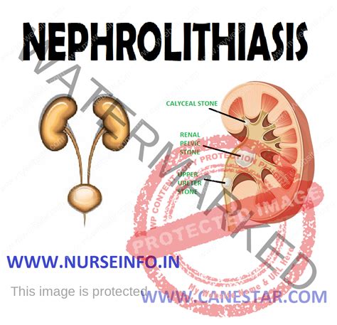 NEPHROLITHIASIS - Nurse Info