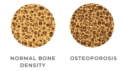 image showing normal bone density vs. osteoporosis - Imaging Center, Minimally Invasive Services