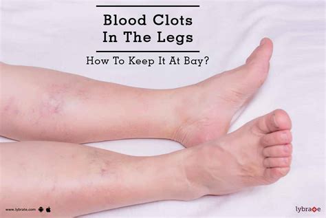 What Do Blood Clots Look Like In Your Legs at Joanne Andrade blog