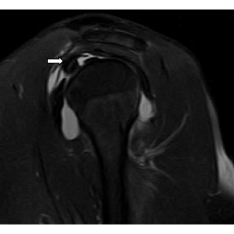 Xray of Shoulder Showing a Solitary Osteochondroma of the Left Scapula ...