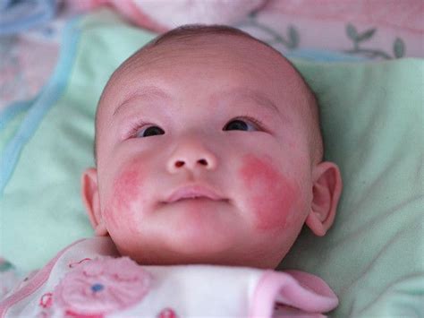 Baby Eczema Symptoms, Causes, Treatments and Triggers - Skin Disease Remedies