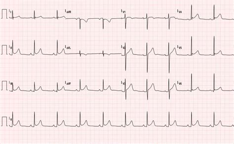 Acute Pericarditis: Electrocardiogram - JETem