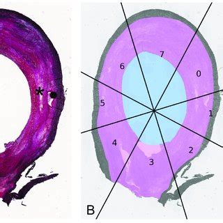 Histology images with WSS data projected onto the lumen. This figure ...