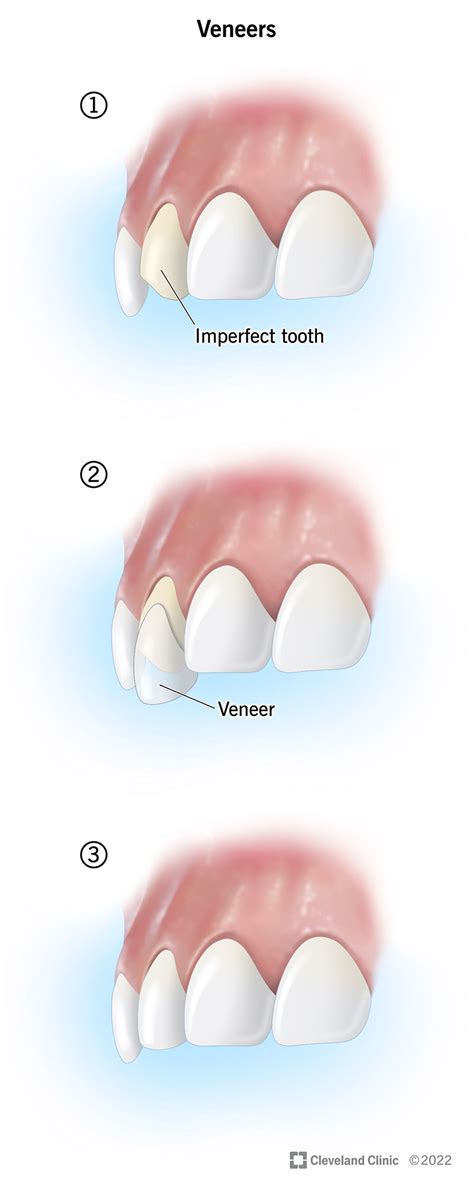 How Do Dental Veneers Work? | Dentist Norcross & Alpharetta, GA