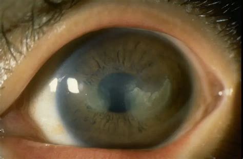 Vernal keratoconjunctivitis - American Academy of Ophthalmology