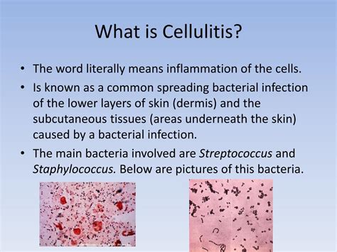 PPT - Cellulitis PowerPoint Presentation, free download - ID:1857729