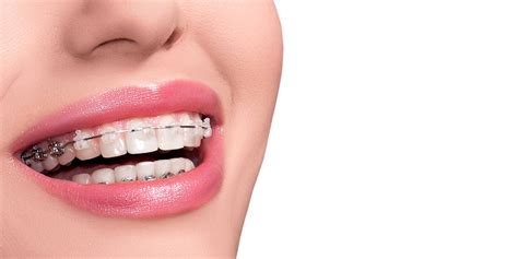 Why Retainers Should Be Worn After Braces | Trambellir