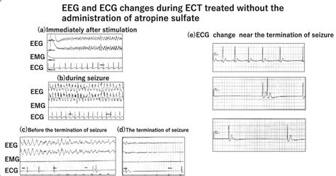 EEG and ECG changes during ECT without administration of atropine... | Download Scientific Diagram