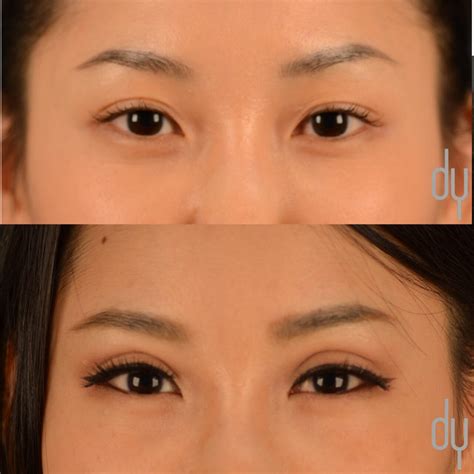 Asian Eyelid Surgery | Asian Blepharoplasty | Asian Eyelid Specialist