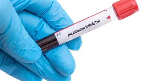 Understanding the Antinuclear Antibody (ANA) Test: Its Role in ...