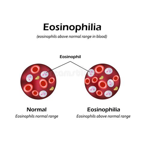 Eosinophils Above Normal Range in Blood. Eosinophilia. Infographics ...