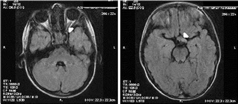 MRI showing optic glioma affecting the optic chiasm; left - thickening... | Download Scientific ...