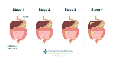 Mesothelioma Stages | Breaking Down the 4 Stages