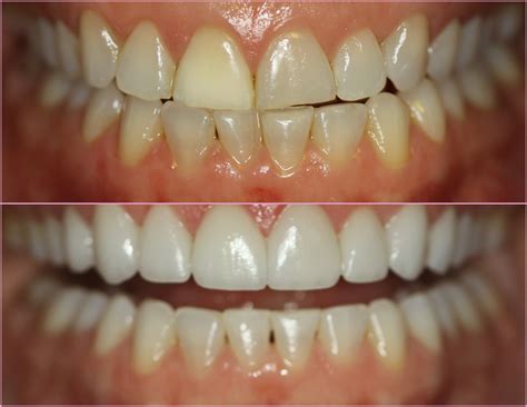 Porcelain Veneers Chicago ~ Before and After ~ July Case of the Month ...