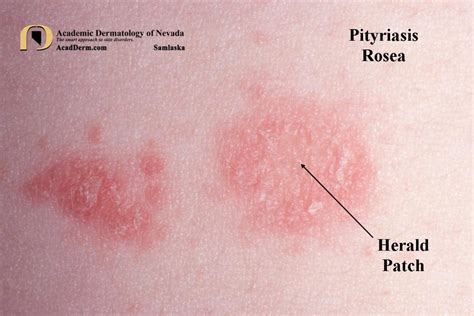 Pityriasis Rosea Herald Patch