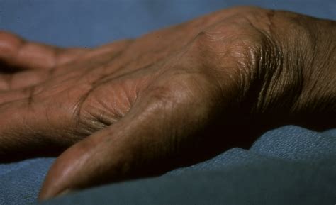 Thenar Muscle Atrophy | Hand Surgery Source