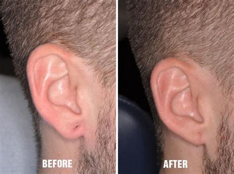 Earlobe Repair Photos | Miami, FL | Patient 1389