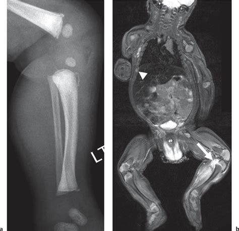 Metaphysis | Radiology Key