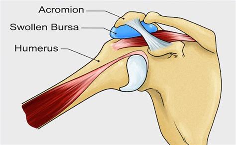 Bursitis Subacromial: Causas, Síntomas, Tratamiento y Prevención - Pmedic