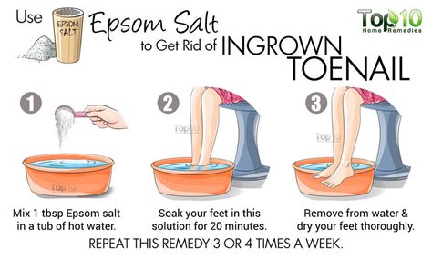 Home Remedies for Ingrown Toenails | Top 10 Home Remedies