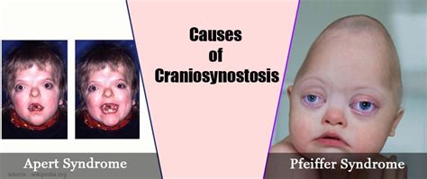 Craniosynostosis - Types, Causes, Symptoms, Diagnosis, Treatment & Prevention