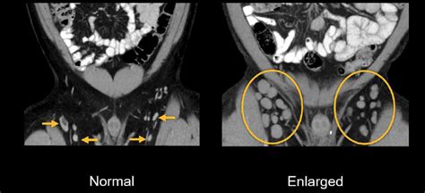 Abdominal CT: lymph nodes • LITFL • Radiology Library