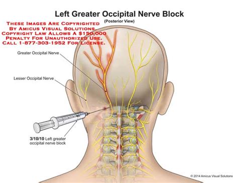 Left Greater Occipital Nerve Block