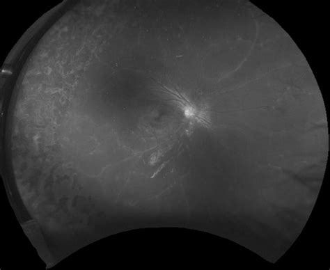 Retinal Vascular Sheathing