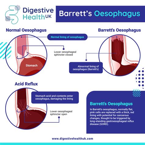 Barrett's oesophagus vs acid reflux: what are the symptoms? - Digestive ...