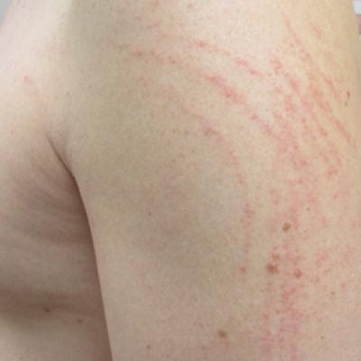 Pruritic and Erythematous Rash Resembling Marks Caused by a Lashing ...