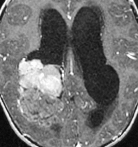 choroid plexus carcinoma - Google Search | Radiology imaging, Radiology, Human anatomy and ...