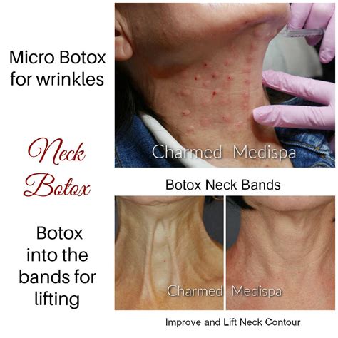 Botox Neck Treatments And What It Helps – Charmed Medispa