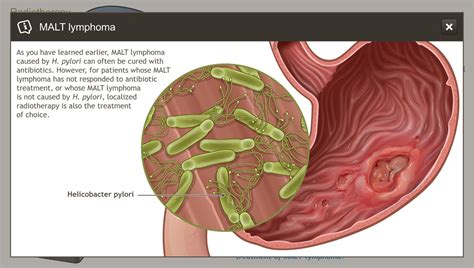 Understanding Indolent Non-Hodgkin Lymphoma-A.D.A.M. OnDemand