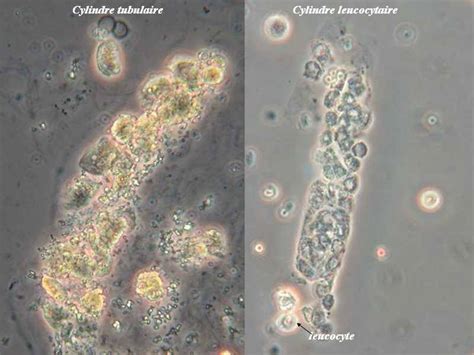 White Cells Casts in Urine | Medical Laboratories