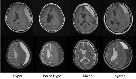 Acute Subdural Hematoma Mri