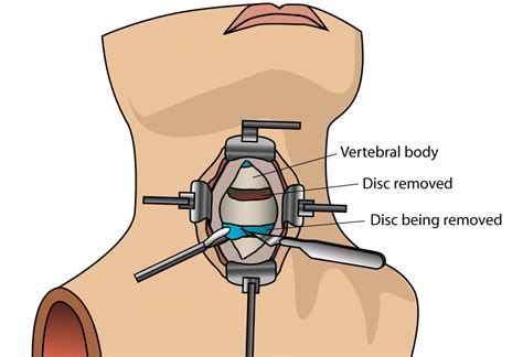 What Is Anterior Cervical Discectomy And Fusion (ACDF)? | London Spine Unit | UK's Best Spinal ...