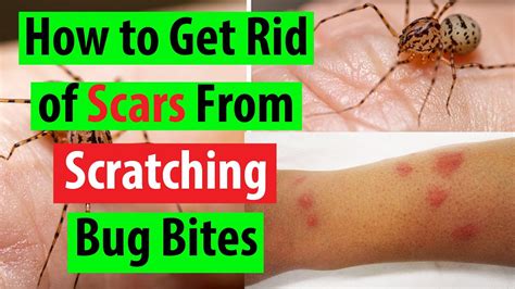 How to Get Rid of Bed Bug Bite Scars: Proven Tips from Bug Experts