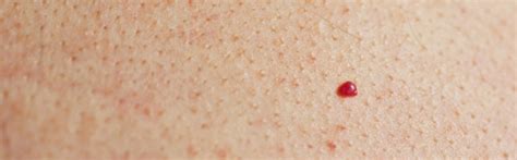 Pictures Of Red Moles On The Body - PictureMeta