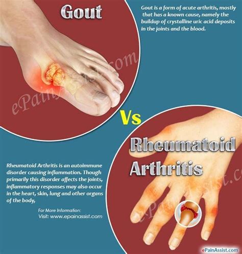 Gout Vs Rheumatoid Arthritis | Rheumatoid arthritis, Gout, Arthritis