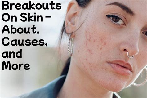 Breakouts On Skin – About, Causes, and More