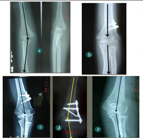 Figure 1 from Cubitus Varus Deformity - Rationale of Treatment and Methods | Semantic Scholar