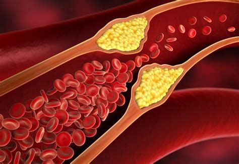 Atherosclerosis, Atherosclerosis or Arteriosclerosis: Symptoms, Causes, Risk Factors and ...