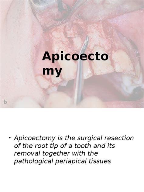 Apicoectomy | PDF