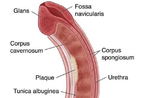 Novel treatment for strictures of the distal penile urethra and fossa navicularis - Mayo Clinic