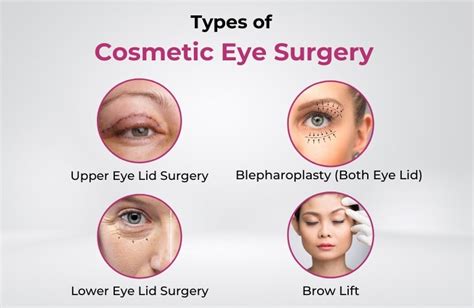 Types of Eye Cosmetic Surgery: From Aesthetics to Vision Correction - M M Joshi Eye Insitute