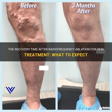 The Recovery Time After Radiofrequency Ablation For Vein Treatment: What To Expect | MedShun