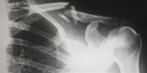 Shoulder Surgery Beats Non-Operative Treatment: New Study | Orthopedics ...